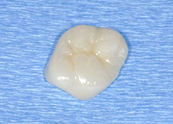 タイプC 強度◎ 大臼歯